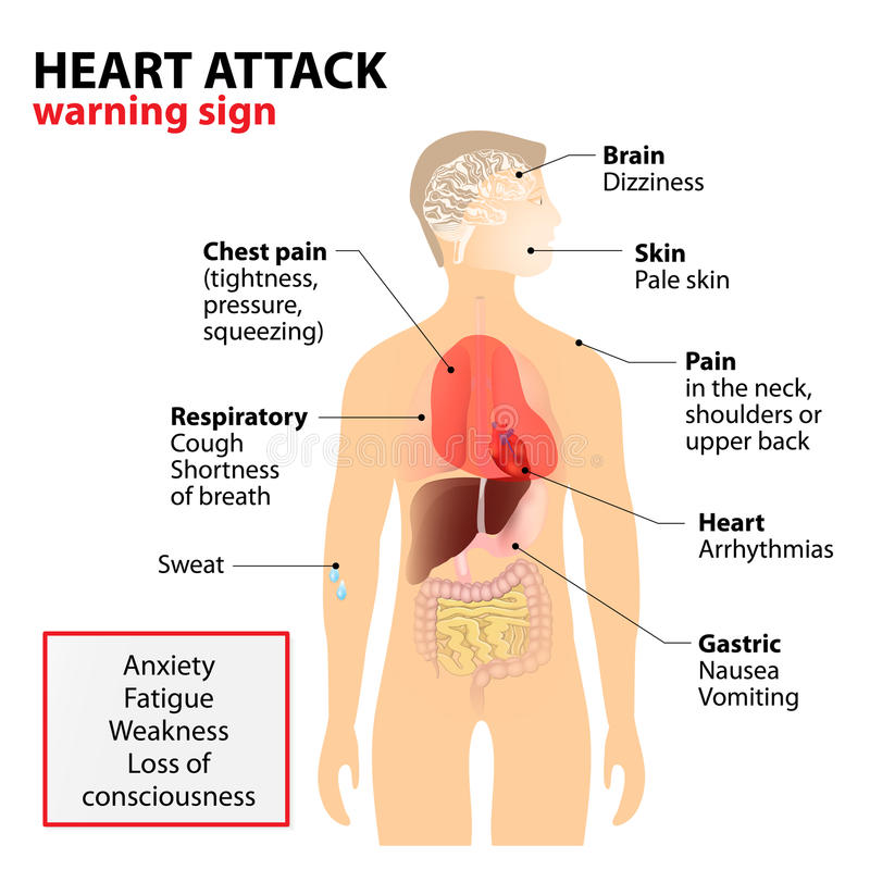 F3   Signes precurseurs de la Crise Cardiaque